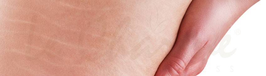 Trattamenti Estetici per smagliature e cicatrici