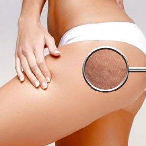 Combatti la cellulite ora!