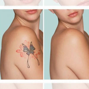 Rimozione dei tatuaggi: come si fa e cosa comporta?